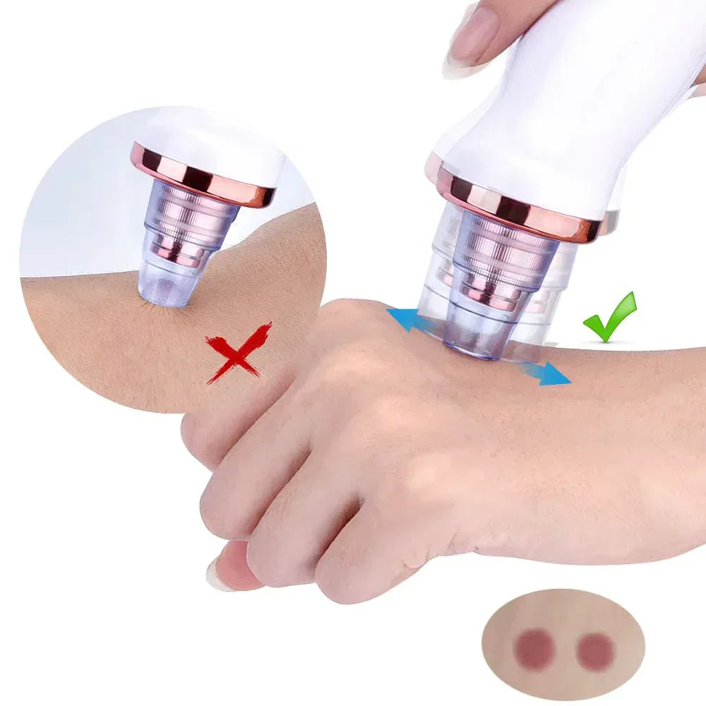 Removedor elétrico de cravos e espinhas a vácuo recarregável usado na mão, com indicação de uso correto e incorreto.