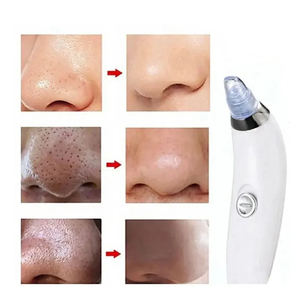 Removedor de Cravos Facial Dermasuction - Puravive Shop